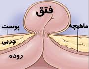 هرنی(فتق کشاله ران) در کودکان 